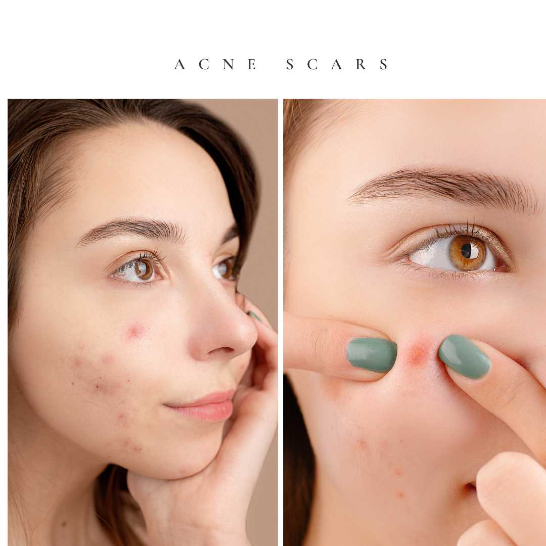 Acne Scars What's the Best Treatment Unveil Top Solutions!_tipsforfits.com