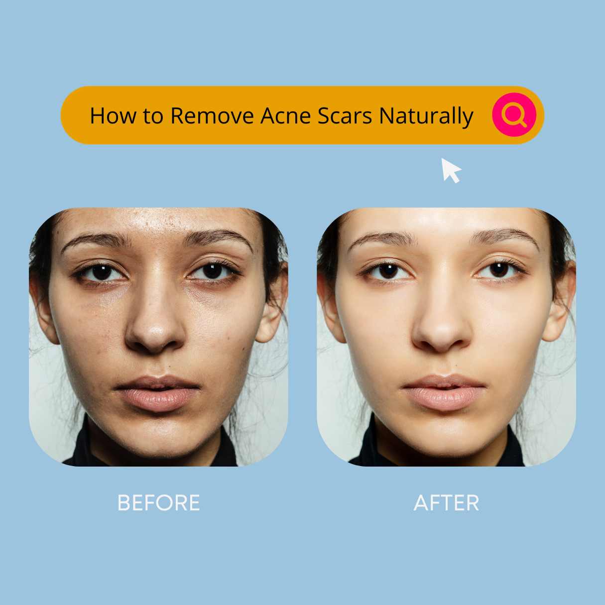 How to Remove Acne Scars Naturally: Proven Home Remedies
